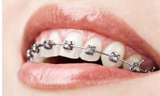 通过整牙调整,改变面部形象及运势:探讨狮子座男与天秤座女在恋爱中的整牙问题