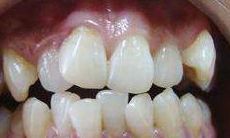 门牙歪斜男人的面相（门牙歪斜的人面相）