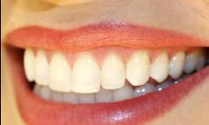 上牙包住下牙的面相（下嘴唇包上嘴唇面相）